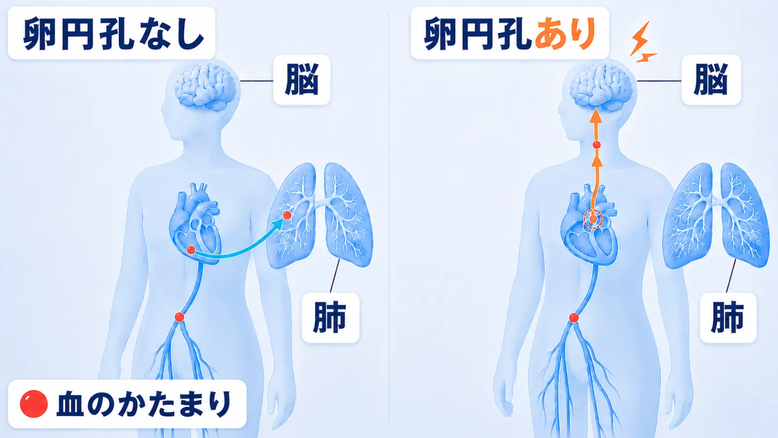 左右2場面の対比図。左「卵円孔なし」では、脚の静脈から上がってきた小さな赤い血のかたまりが心臓の右側の部屋に入り、水色の矢印で肺へ運ばれて肺の中で止まり、脳には何も届かない。右「卵円孔あり」（「あり」はオレンジ色）では、心臓の上半分の壁にある小さな穴（破線の丸）を通り抜けた血のかたまりが肺を素通りし、オレンジの矢印で首を通って脳へ向かい、脳のそばに小さなギザギザの光がある。左下に「赤い丸＝血のかたまり」の凡例。ラベルは「脳」「肺」