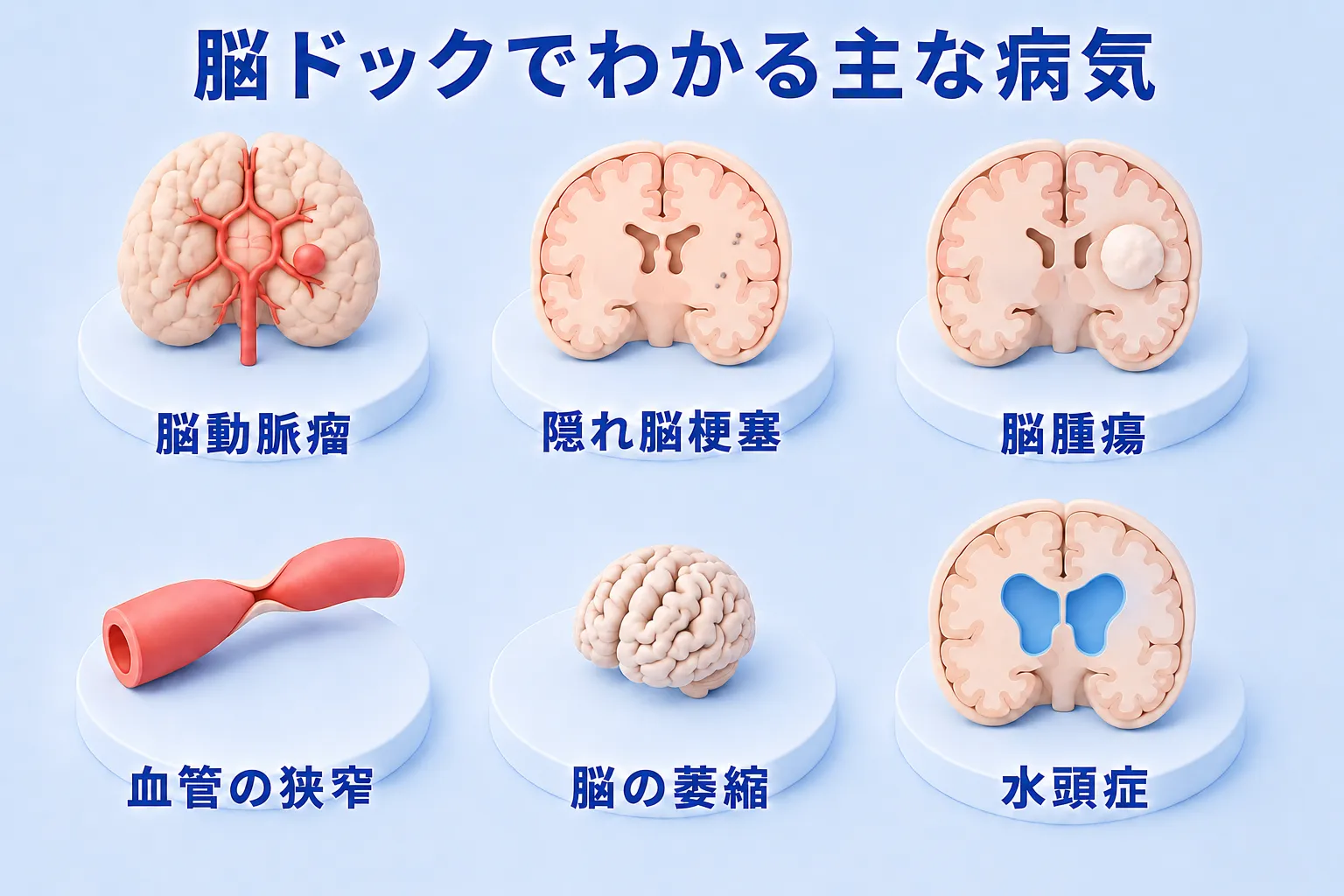 脳ドックでわかる主な病気の図。脳動脈瘤、隠れ脳梗塞、脳腫瘍、血管の狭窄、脳の萎縮、水頭症の6つを、脳と血管の模型で表している。