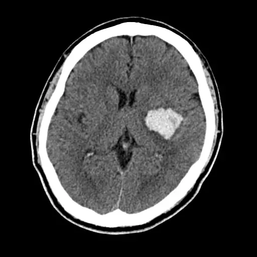 脳出血の頭部CT。脳の左側の深い部分に、白く（明るく）写る血のかたまりが確認できる。点線の丸で出血の場所を示している。