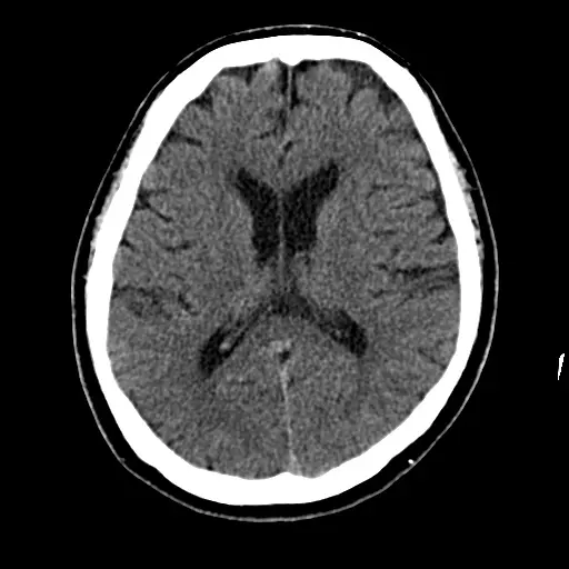 健常な方の頭部CT。左右対称に脳が写り、白く目立つ出血のような部分は見当たらない。