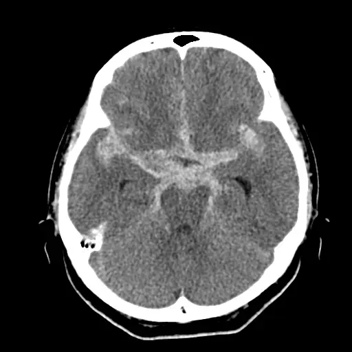 くも膜下出血の頭部CT。脳の底の溝に沿って、白い出血が広がって写っている。点線の楕円で出血の広がりを示している。