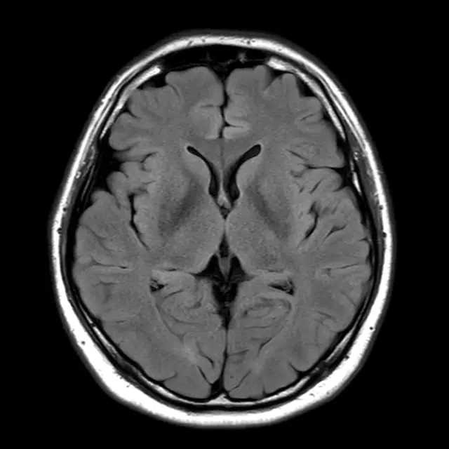 健常な方の頭部MRI。左右対称に脳が写り、白く強く光る部分はみられない。