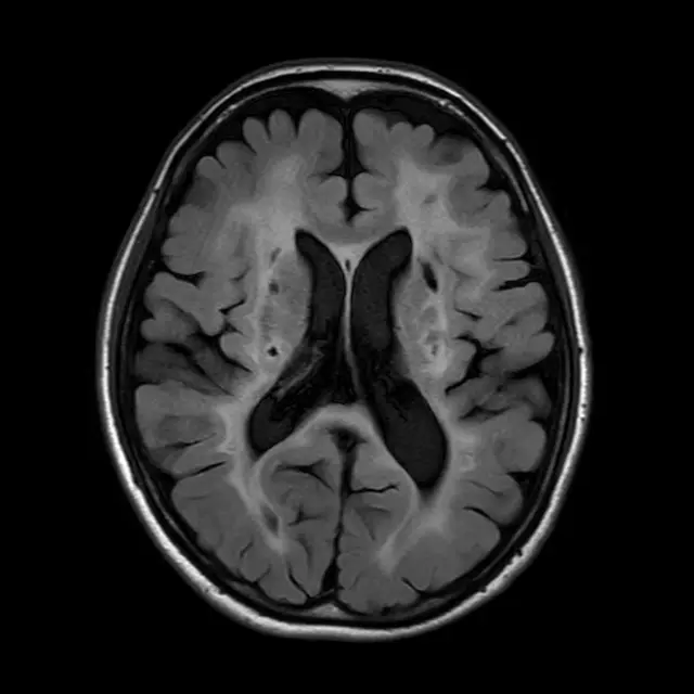 血管性認知症の頭部MRI（脳室の高さの断面）。脳室のまわりの白質が左右とも白くにじみ、黒く抜けた古い脳梗塞の跡も写っている。