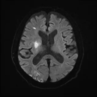 アテローム血栓性脳梗塞のMRI（拡散強調画像）。同じ血管の領域に、大小の白い梗塞が複数散らばって写っている。点線の丸で示している。