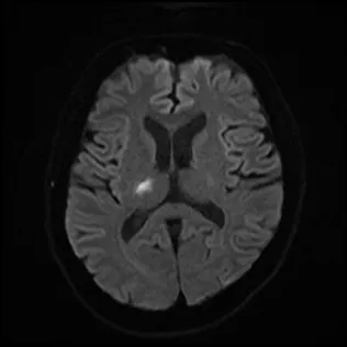 小さな脳梗塞（ラクナ梗塞）のMRI（拡散強調画像）。脳の深い部分に、小さく白く光る点が確認できる。点線の丸で場所を示している。