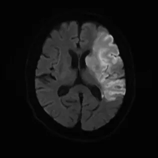 広範囲の脳梗塞のMRI（拡散強調画像）。脳の片側の広い範囲が白く光っている。点線の楕円で範囲を示している。