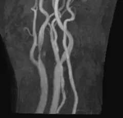 首の血管（頸動脈）のMRA画像。動脈硬化で血管が細くなっている部分を矢印で示している。