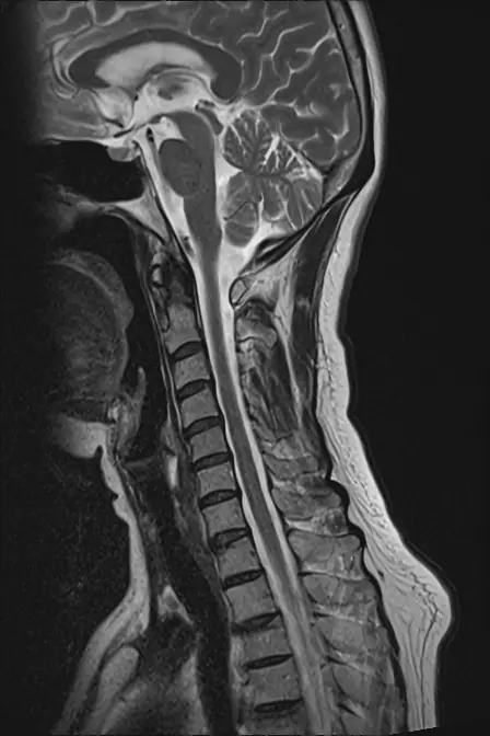 正常な頸椎（首の背骨）のMRI。背骨と、その中を通る神経（脊髄）がなめらかに写っている。