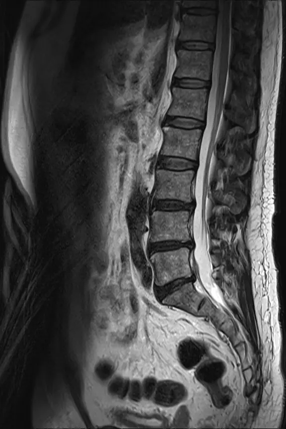 正常な腰椎（腰の背骨）のMRI。背骨と神経の通り道が整って写っている。