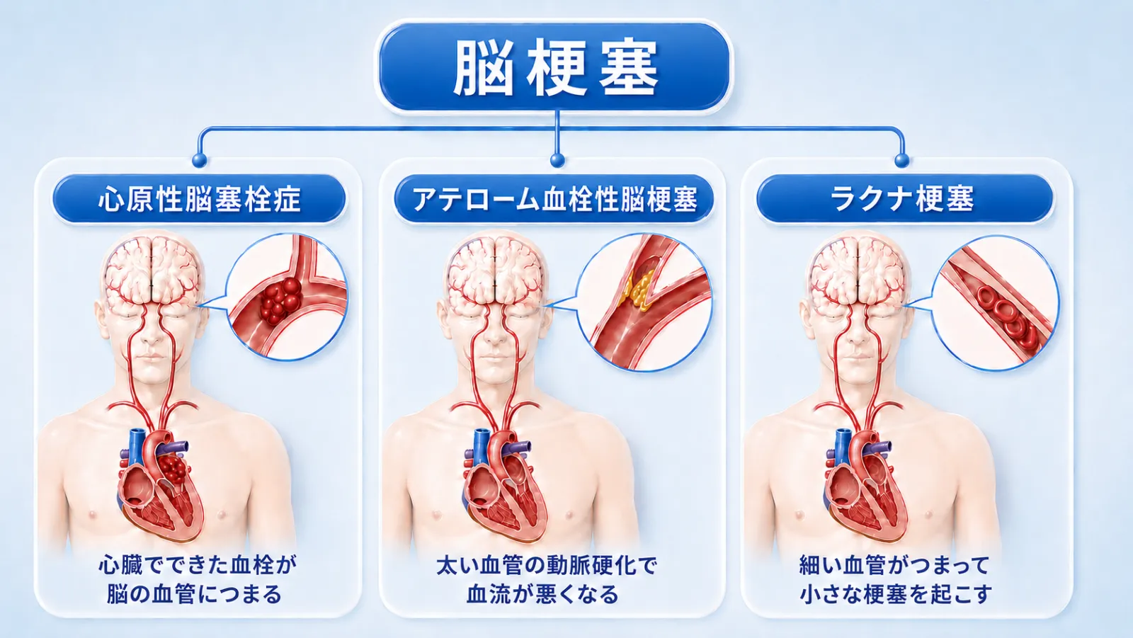 脳梗塞の3つの病型を人体図で示した図解。心原性脳塞栓症＝心臓でできた血栓が脳の血管につまる、アテローム血栓性脳梗塞＝太い血管の動脈硬化で血流が悪くなる、ラクナ梗塞＝細い血管がつまって小さな梗塞を起こす、の3つを、脳と心臓・血管の拡大図とともに並べている。