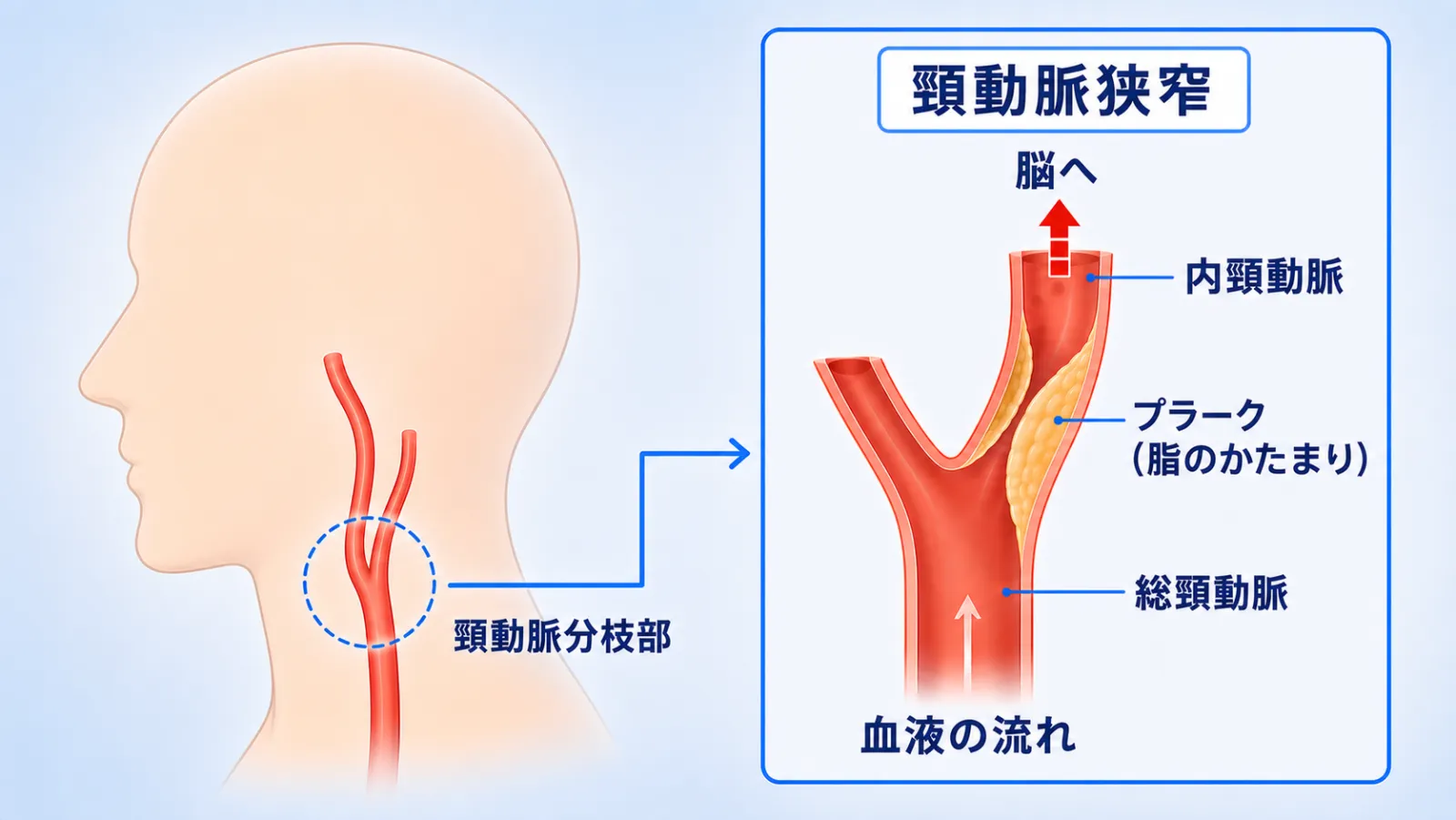 頸動脈狭窄のしくみを示す図。左に横向きの頭部と首の輪郭を描き、首を通る血管があごの下でY字に分かれる「頸動脈分枝部」を丸で囲んで示している。右の拡大図では、総頸動脈から内頸動脈へ分かれる部分の血管の内側に、プラーク（脂のかたまり）が盛り上がって血液の通り道が細くなっている様子と、下から上へ脳に向かう血液の流れを描いている。