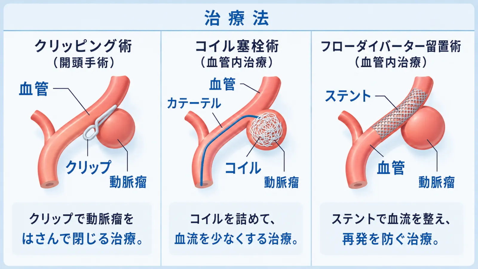 未破裂脳動脈瘤の主な治療法を3つ並べた図解。クリッピング術（開頭手術で動脈瘤の根元をクリップで挟んで閉じる）、コイル塞栓術（血管内治療でカテーテルからコイルを詰めて血流を少なくする）、フローダイバーター留置術（血管内治療でステントを置いて血流を整え、再発を防ぐ）の3つを、それぞれ血管・動脈瘤と器具のイラストで示している。