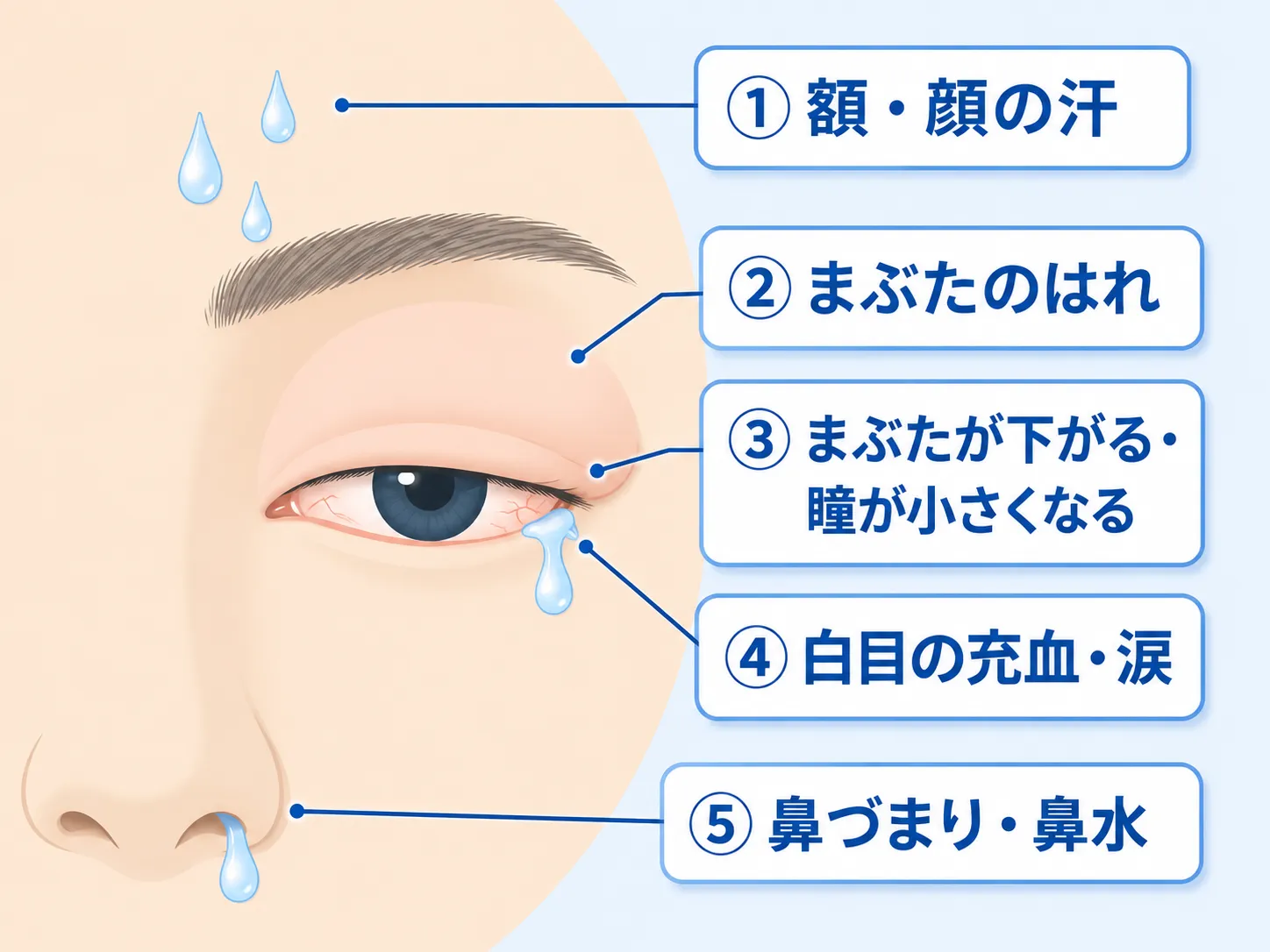 群発頭痛の発作中に、痛みと同じ側の顔に現れる自律神経症状を示した顔のクローズアップ図。①額・顔の汗、②まぶたのはれ、③まぶたが下がる・瞳が小さくなる、④白目の充血・涙、⑤鼻づまり・鼻水、の5つのサインを番号付きラベルで示している。