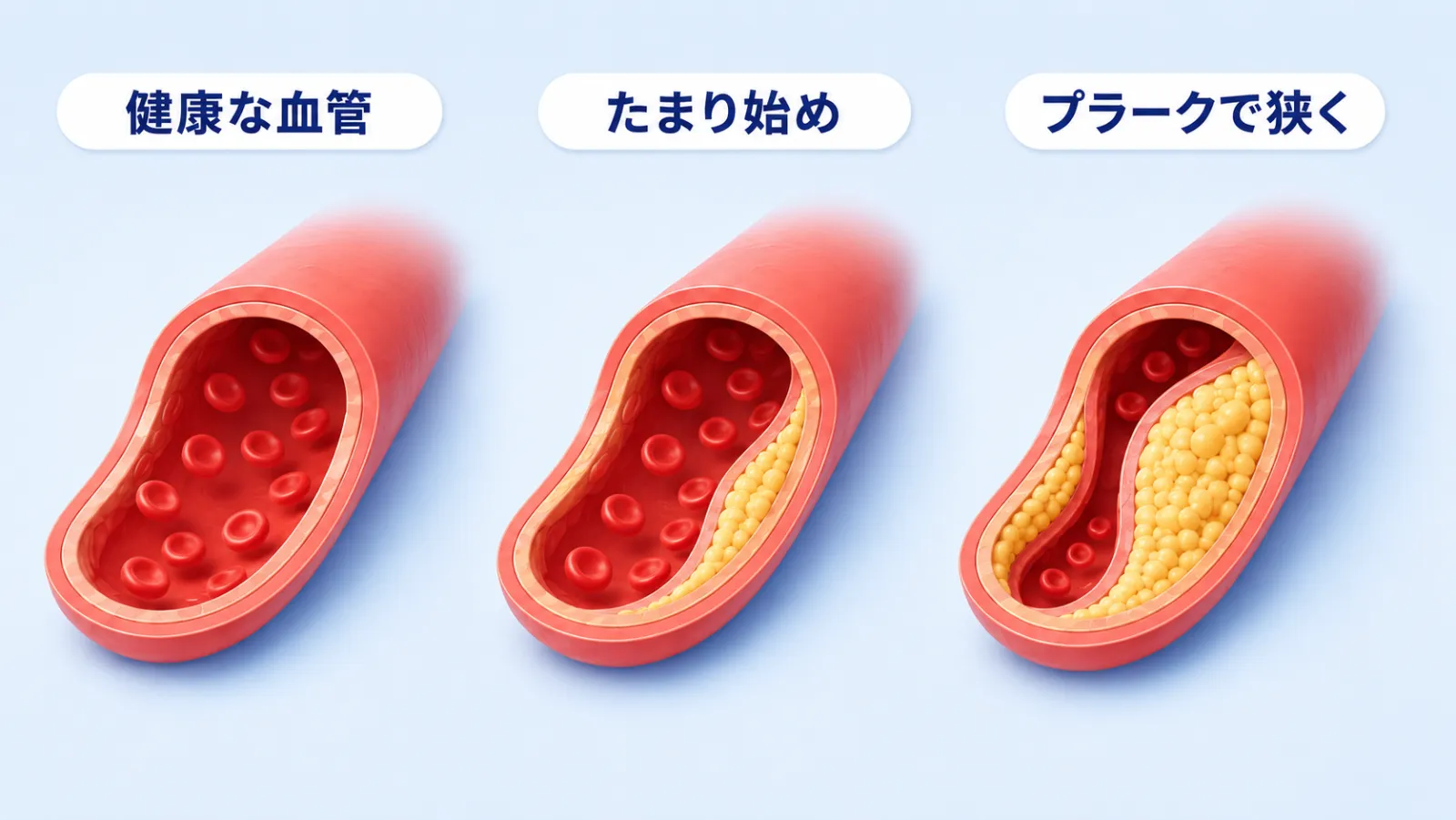 動脈硬化が進む様子を血管の断面3つで示した図。左は健康な血管、中央は壁の内側にコレステロールがたまり始めた血管、右はプラークが育って血液の通り道が狭くなった血管。