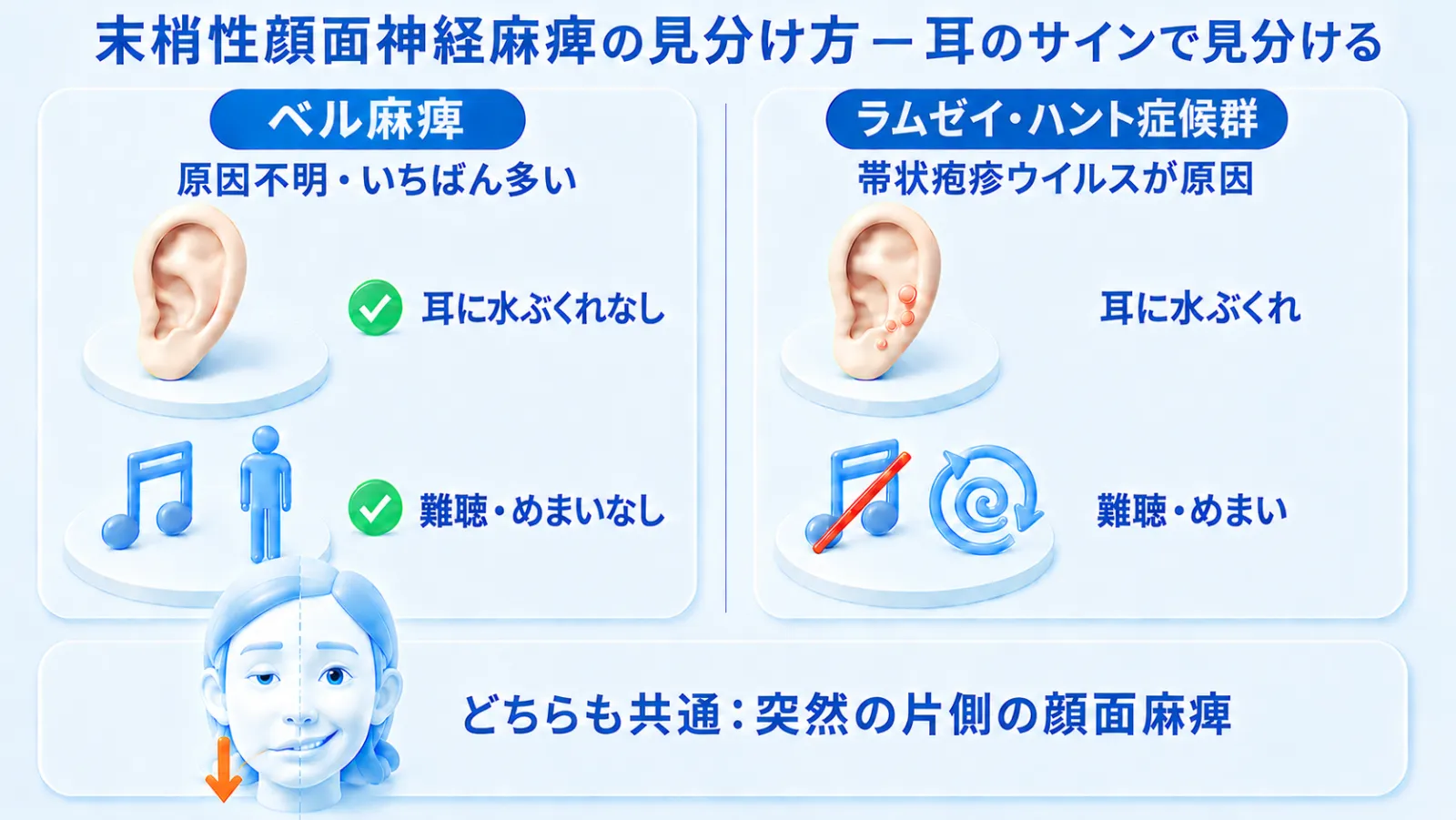 末梢性顔面神経麻痺の代表2疾患を耳のサインで見分ける図解。左「ベル麻痺（原因不明・いちばん多い）」は耳に水ぶくれがなく、難聴・めまいも伴わない。右「ラムゼイ・ハント症候群（帯状疱疹ウイルスが原因）」は耳に水ぶくれがあり、難聴・めまいを伴う。下部に、どちらにも共通する突然の片側の顔面麻痺（片側の口角が下がり頬がたるんだ顔）を示している。