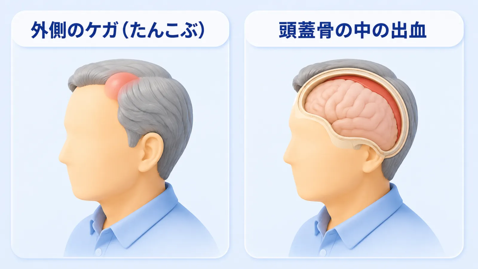 外側のケガと頭蓋骨の中のケガは別物であることを示す左右対比の図解。左の「外側のケガ（たんこぶ）」は、頭皮の上にふくらみができている。右の「頭蓋骨の中の出血」は、頭の断面で、頭蓋骨のすぐ内側に沿って血の層がたまっている様子を示している。