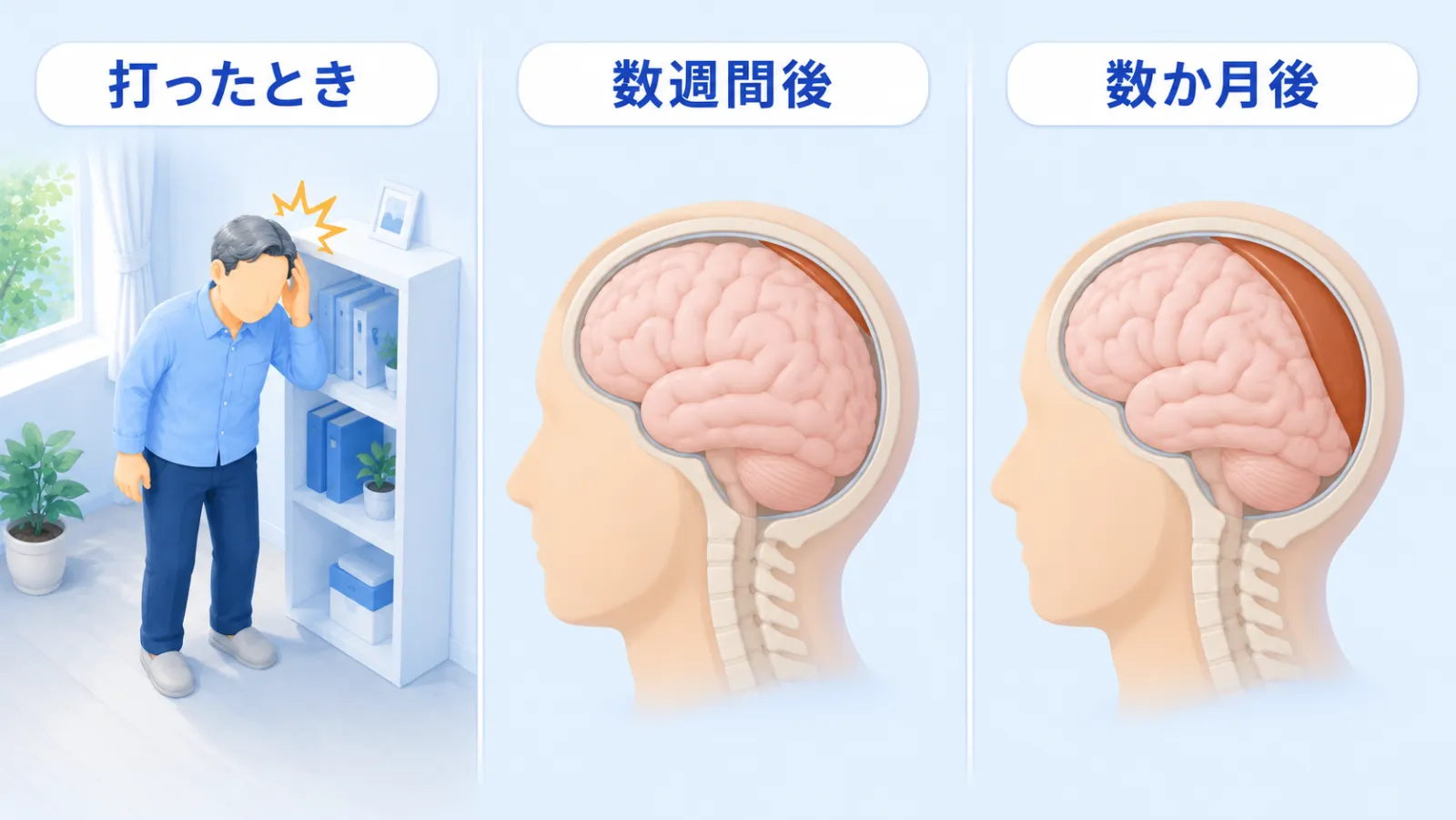 慢性硬膜下血腫が起こるまでを、左から右へ時間順に3コマで示した図解。「打ったとき」＝棚の角に頭を軽くぶつける。「数週間後」＝頭の断面で、頭蓋骨のすぐ内側に沿った薄い三日月形のたまりがうっすら現れる。「数か月後」＝たまりが厚くなり、脳を内側に押している。