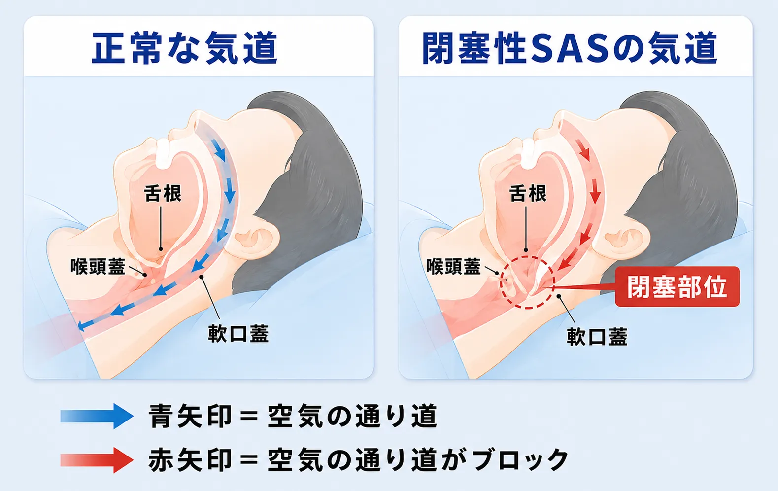正常な気道と閉塞性睡眠時無呼吸の気道を横から比べた図。眠るとのどの奥（舌根・軟口蓋）が落ち込み、空気の通り道がふさがるしくみを示す。