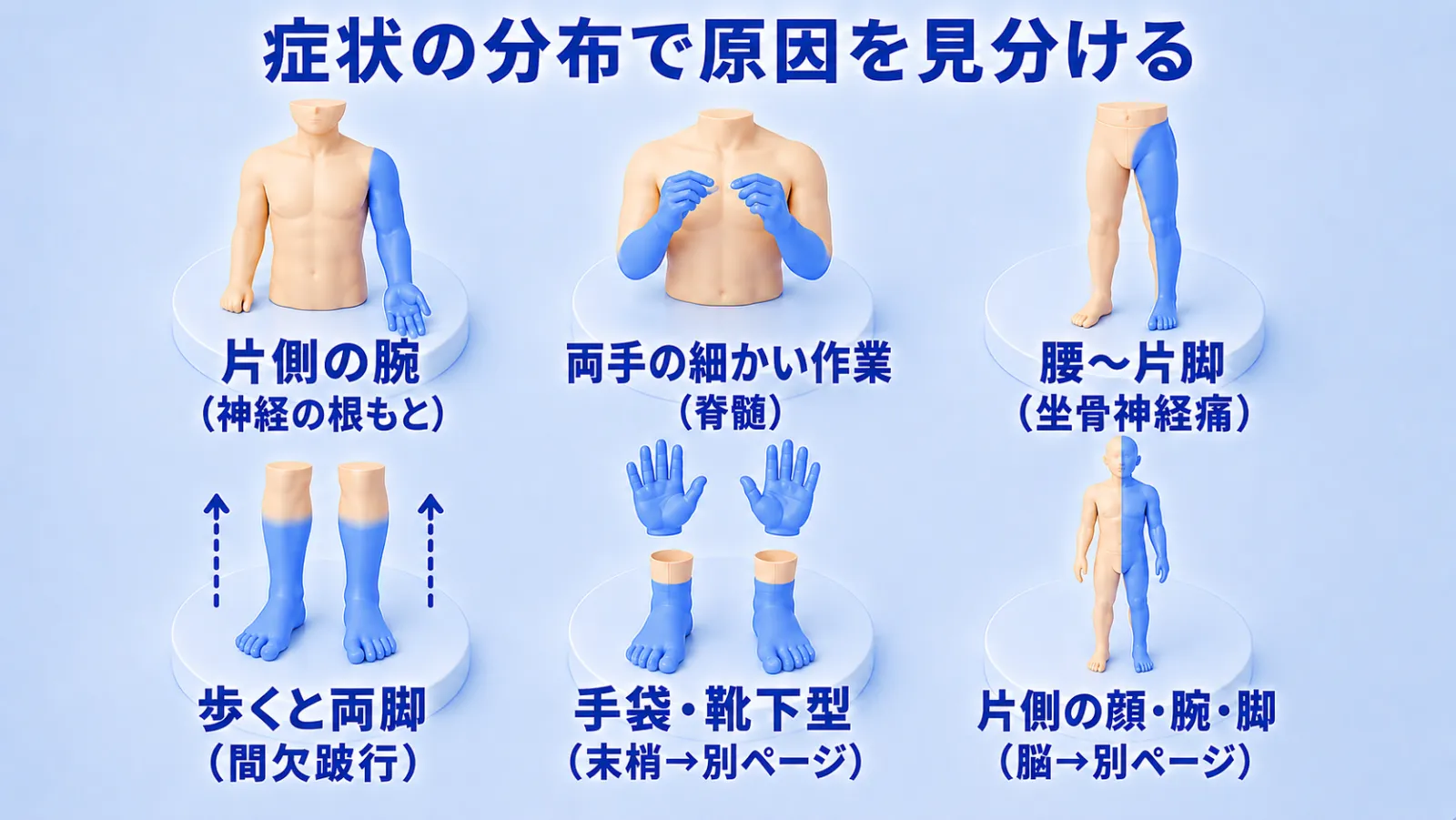 症状の分布で原因を見分ける6つの図。上段＝片側の腕だけが青（神経の根もと）／両手を胸の前で動かし両手が青（両手の細かい作業＝脊髄）／片側の腰から片脚が青（坐骨神経痛）。下段＝両脚が青く上向き矢印で歩くと強まる（間欠跛行）／両手先・両足先が左右対称に青（手袋・靴下型＝末梢、別ページ）／全身の片側半分が青（片側の顔・腕・脚＝脳、別ページ）。