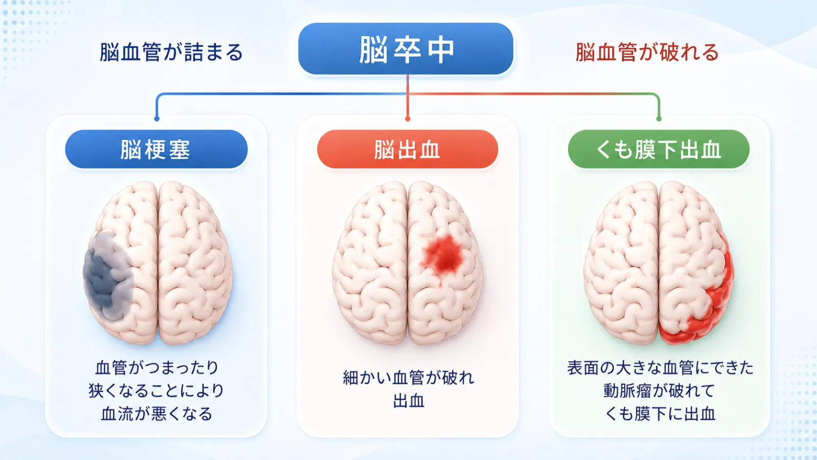 脳卒中の3つのタイプを示した図。血管が詰まる脳梗塞、血管が破れる脳出血、動脈瘤が破裂するくも膜下出血の3つをイラストで比べている。